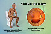 Valsava retinopathy, illustration