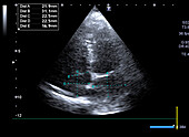 Atrial volume, ultrasound scan