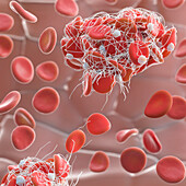 Blood clot, illustration