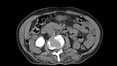 Kidney stone, CT scan