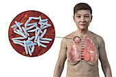 Woman with apical tuberculosis, illustration