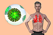 Man with lungs affected by Covid-19 pneumonia, illustration