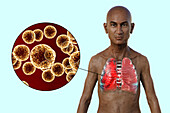 Man with lungs affected by pneumonia, illustration