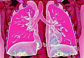 Lungs, CT scan