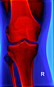 Right knee, X-ray