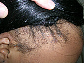 Traction alopecia