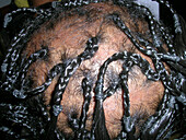 Traction alopecia