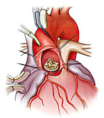 Surgical placement aortic valve graft, illustration