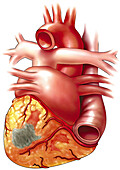 Large myocardial infarction, illustration
