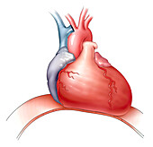 Cardiomegaly, illustration