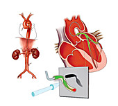 Cardiac catheterization, illustration