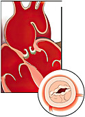 Incompetent aortic valve, illustration