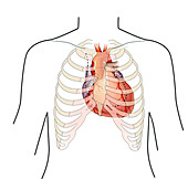 Heart anatomy with ribs, cardiomegaly, illustration