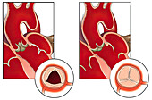 Normal aortic valve function, illustration