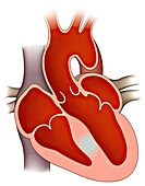 Ventricular septum infarction, illustration