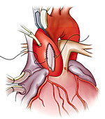 Valve surgery, illustration