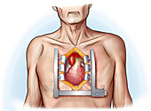 Cardiac surgery , illustration