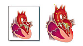 Acute infective endocarditis, illustration