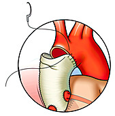 Suturing graft to ascending aorta, illustration