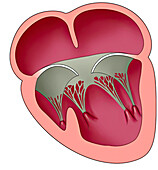 Complex single ventricle malformation, illustration