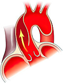 aortic root with intimal rupture, illustration