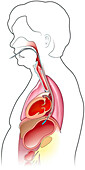 Orogastric tube insertion, illustration