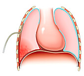 Lung contusion with haemothorax, illustration