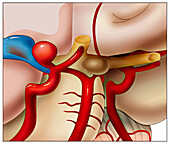 Berry aneurysm at the circle of Willis, illustration