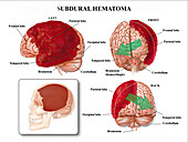 Subdural haematoma, illustration