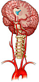 Berry aneurysms, illustration