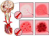 Progression of embolic stroke, illustration