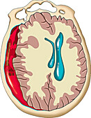 Subdural haematoma, illustration