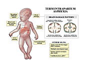 Term intrapartum asphyxia and brain damage, illustration
