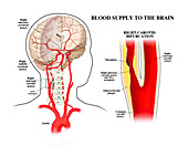 Carotid artery disease, illustration