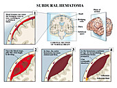 Subdural haematoma, illustration