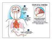 Foetal stroke, illustration