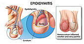 Epididymitis, illustration