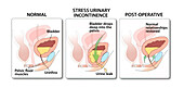 Stress urinary incontinence, illustration