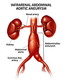 Infrarenal abdominal aortic aneurysm, illustration
