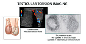 Testicular torsion imaging, illustration