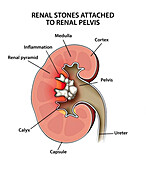 Renal pelvic stones, illustration