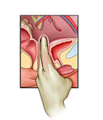 Post-hysterectomy pelvic exam, illustration