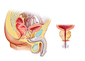 Benign prostatic hypertrophy, illustration