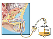 Foley catheter, illustration