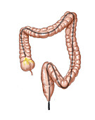Flexible colonoscopy, illustration