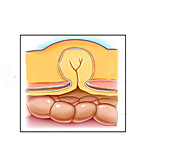 Ventral hernia, illustration