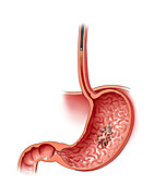 Stomach cancer with esophagoscope, illustration