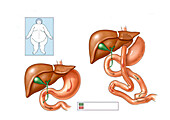 Roux-en-Y gastric bypass, illustration