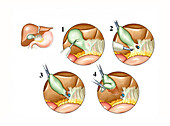 Laparoscopic cholecystectomy, illustration