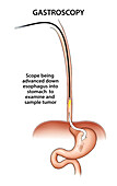 Gastroscopy, illustration